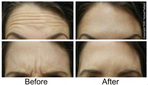 Before and after Botox for wrinkles